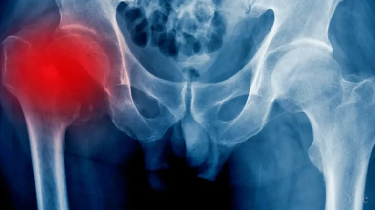 Osteonecrosis