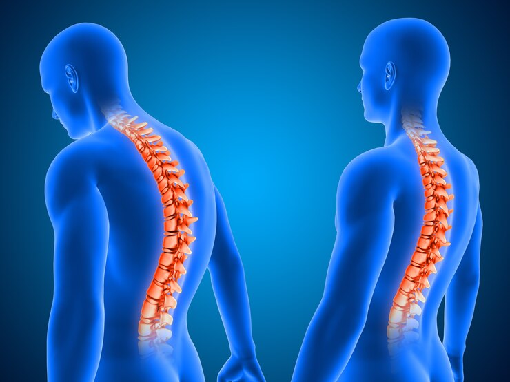 Herniated Discs