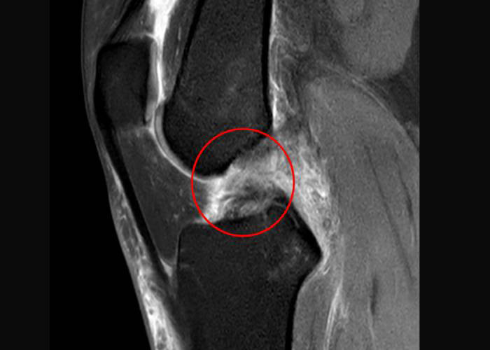 Concomitant Injuries