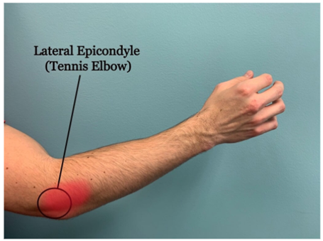 Tennis Elbow
