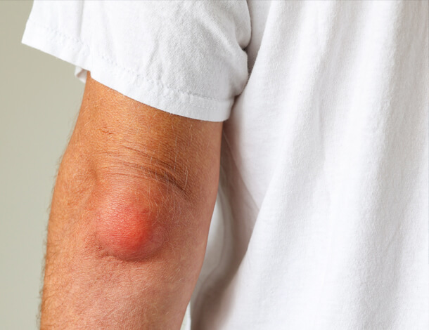 Bursitis