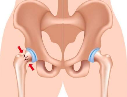 Hip fractures