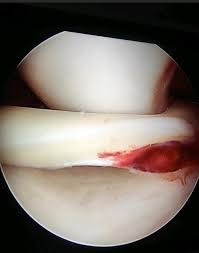 Traumatic Injury
