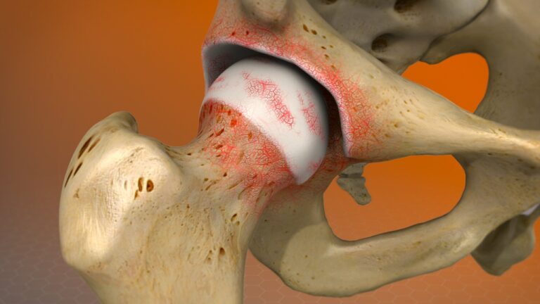 Arthritis