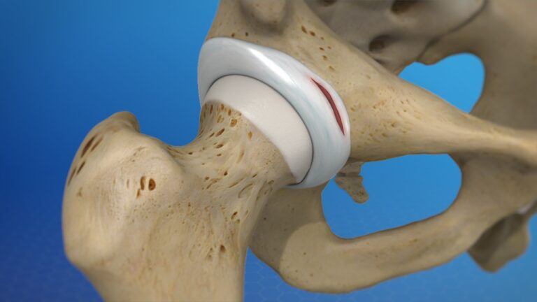Labral Tear