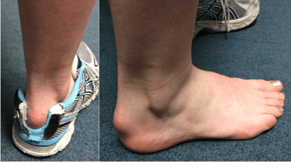 Bursitis